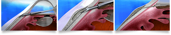 Xen Gel Stent Florida Eye Specialists