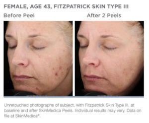 Skinmedica Peel Before and After
